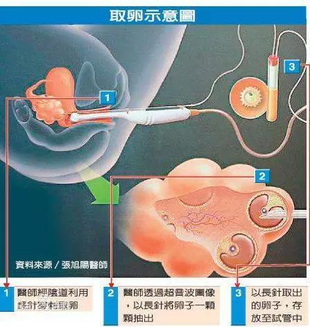 供卵女孩(供卵女孩：生育之路的选择与挑战”)